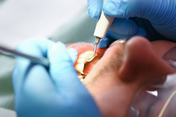 Best Emergency Tooth Extraction in Bridgetown, OH