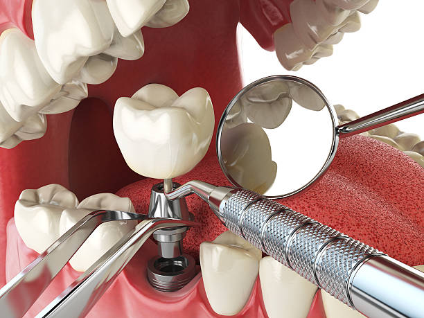 Best Emergency Wisdom Teeth Removal in Bridgetown, OH